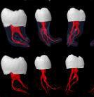 Ендодонтія. Лікування кореневих каналів, жувальні зуби(6й,7й).