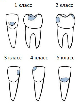 Лікування карієсу