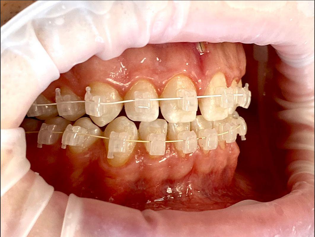 Ортодонтія. Встановлення брекет-системи.